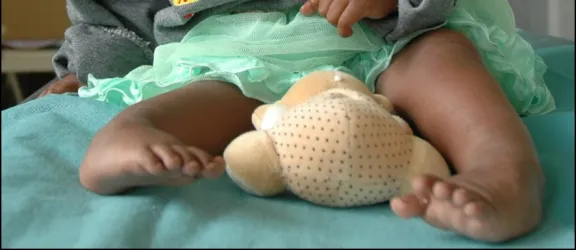 lächelndes Kind mit beidseitigen Klumpfüßen