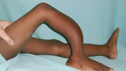 Mädchen mit stark verkrümmten Bein durch Fluorose